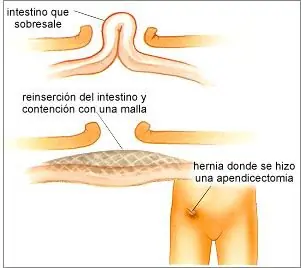 Hernias En El Síndrome de Ehlers Danlos - Parte 2