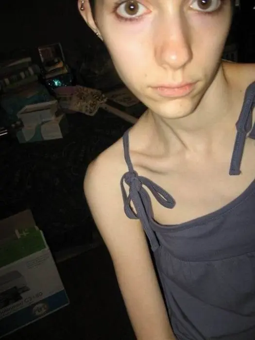 anorexia