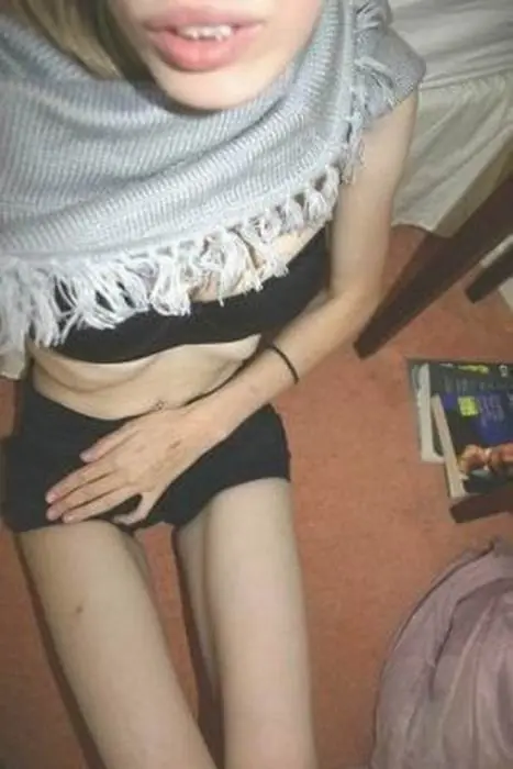 anorexia