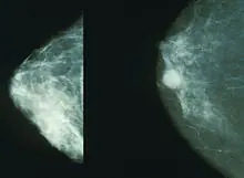 cancer