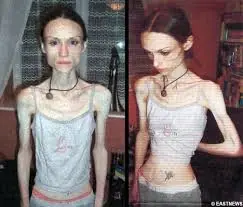 que es la anorexia