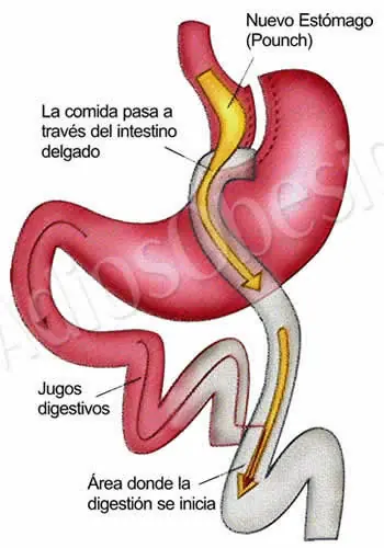 Cirugias para la obesidad.