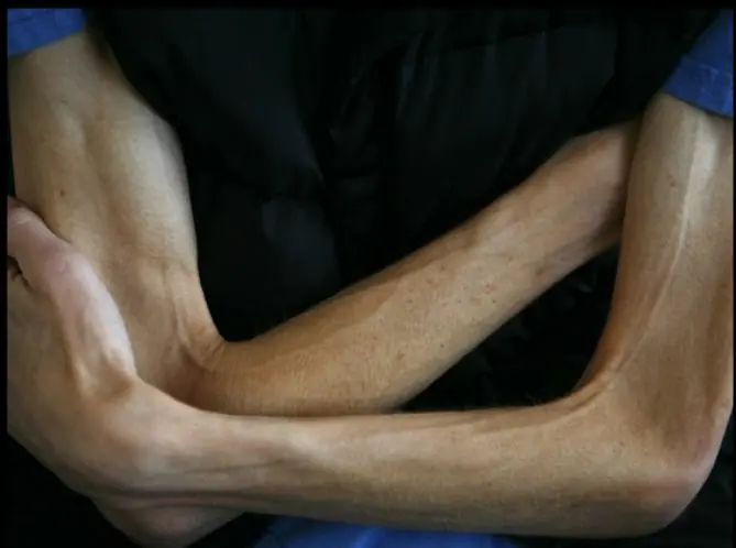 Anorexia En Los Hombres