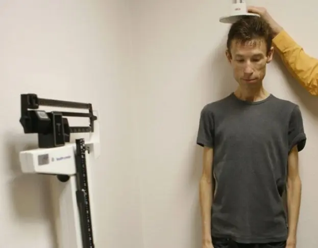 anorexia