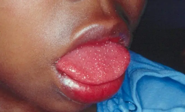 sindrome de