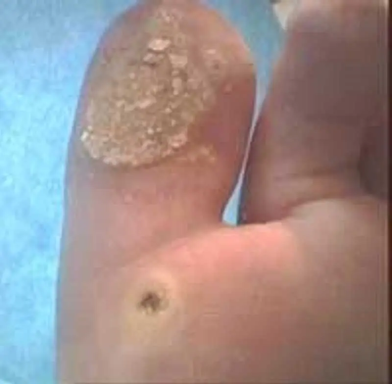 Eczema