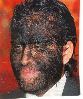 Las 10 Enfermedades Más Raras en Medicina