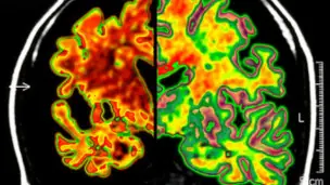Ser bilingüe protege al cerebro de la demencia