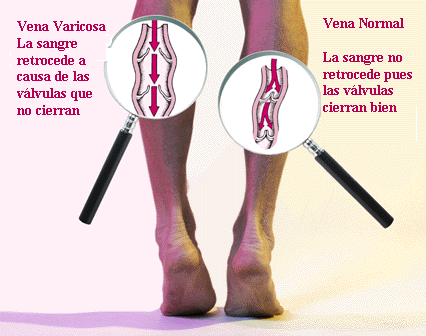 piernas
