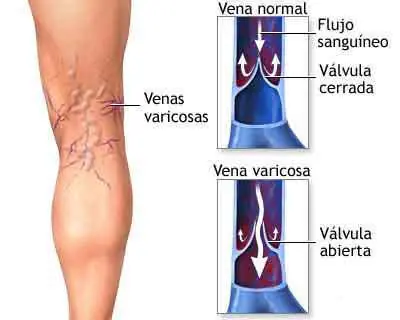 Varices o Venas Varicosas
