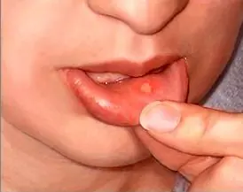 Curar llagás en la boca (fácil y rápido)