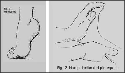 ¿Qué es la rizotomía?