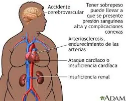 obesidad