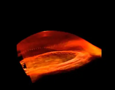 Un mapa en 3D de la córnea en menos de un segundo