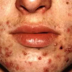 Combatamos juntos el acne.