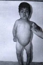 Discapacidad: Evaluaciones psicométricas