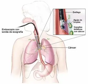 Todo sobre el cancer,Parte 2 ¡¡