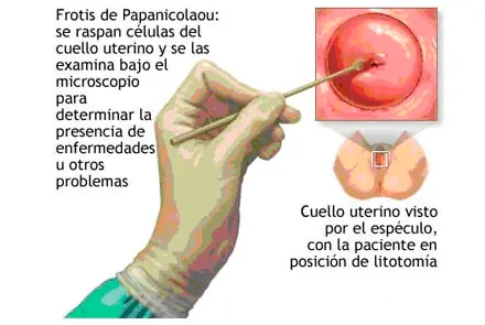 Citología Vaginal