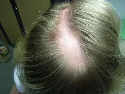 Alopecia Areata