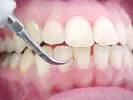 caries