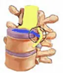Tratamiento de la lumbalgia