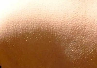 ¿Porque se nos pone la piel de gallina?