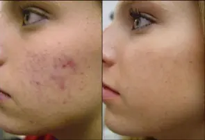 cicatrices de acne