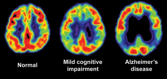 Se podrìa diagnosticar el Alzheimer,gracias a una proteìna