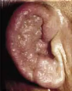 pseudomonas y basilos