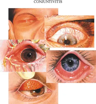 Conjuntivitis: Síntomas y Tratamientos