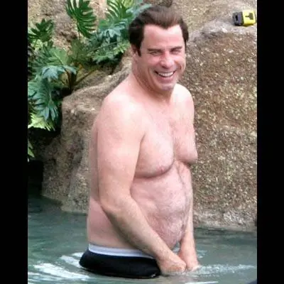 gynecomastia