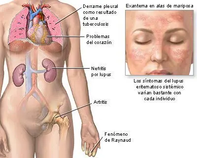 LUPUS, tienes que leer esto