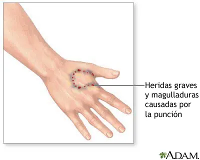 A mi hijo lo mordieron ¿qué debo hacer?