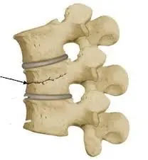 fractura de vertebra lumbar
