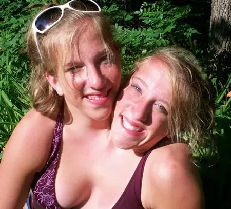 hermanas siamesas