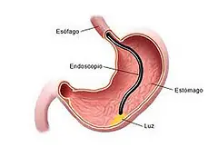 celiaco