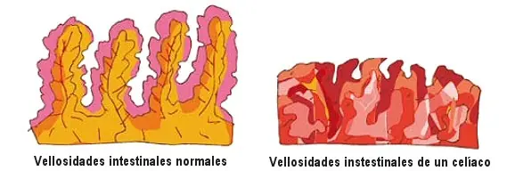 enfermedad