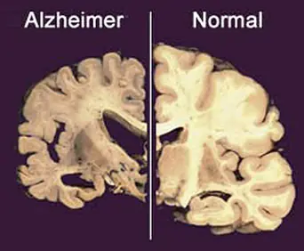Operación de cataratas servirá para detectar el Alzheimer