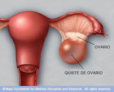ovaricos