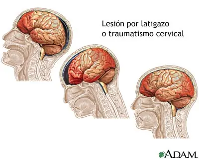 Traumatismo de craneo