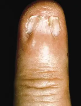 Es malo comerse las uñas,consecuencias...