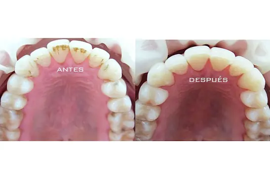 Mi historia con brackets (¡Actualizable!)