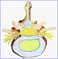 Fisura, protusión y hernia discal