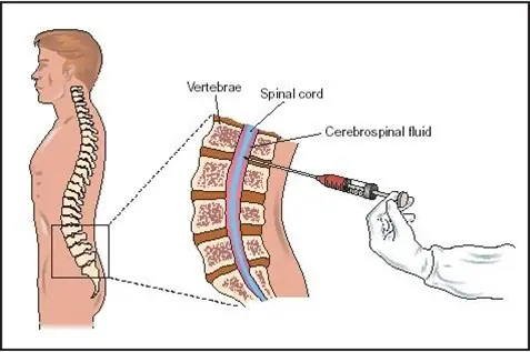 Puncion lumbar
