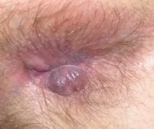 enfermedades