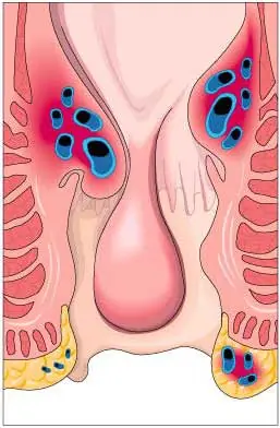 Hemorroides (que dolor) editado