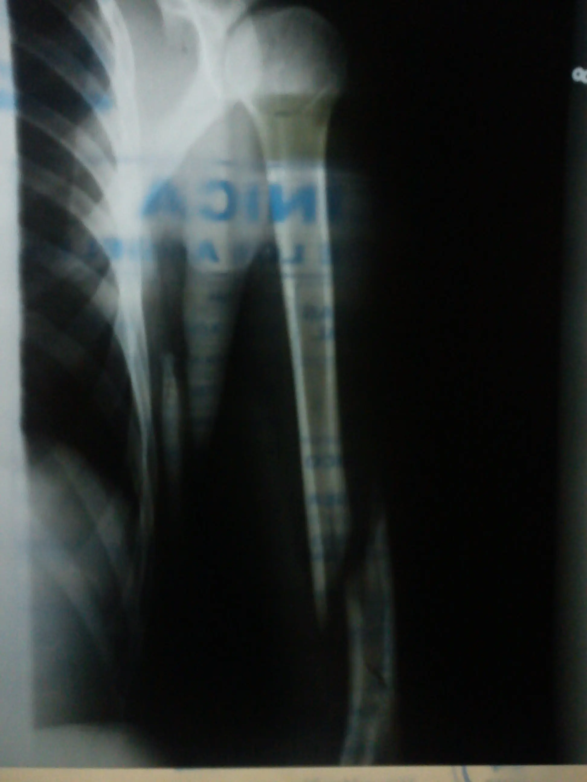 No dejes que una lesión te derrumbe, Motivate.