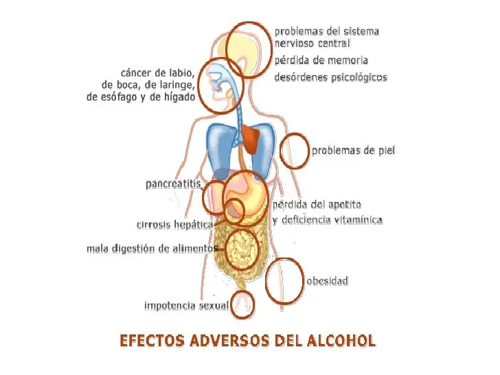 Alcoholismo los riesgos del alcohol entre los jóvenes