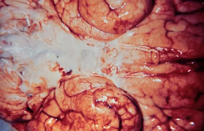 Meningitis