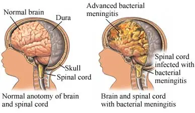 cerebro